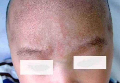 孩子脸上长白斑都是蛔虫惹的祸这些皮肤病要警惕