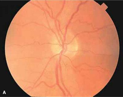 非动脉炎性前部缺血性视神经病变