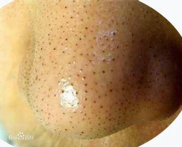 2,黑头粉刺:属称黑头,其特征为明显扩大的毛孔中的黑点,挤出后形如