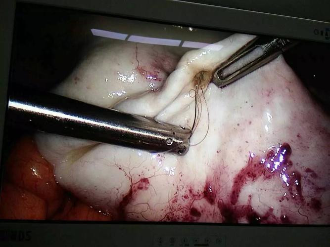 平原县中医院妇产科成功完成一例腹腔镜下卵巢畸胎瘤摘除手术