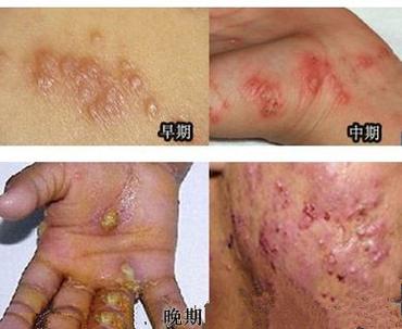 疥疮是由于疥虫感染皮肤引起的皮肤病,疥疮的传播迅速,疥疮是通过密切