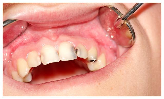 孩子蛀牙前期有三大表现,家长越早发现对孩子的牙齿更好