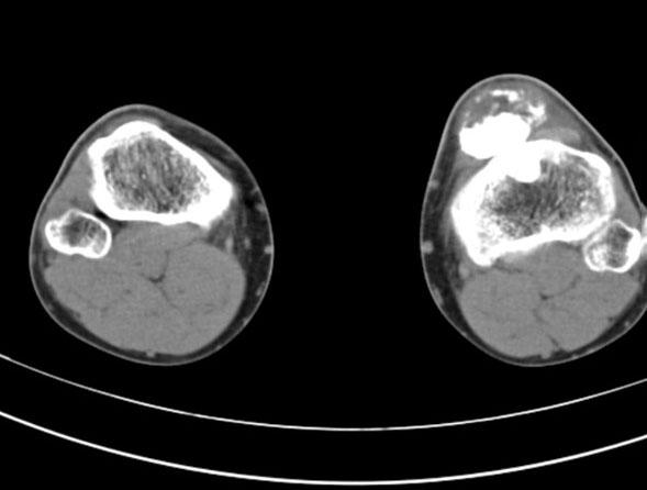 左胫骨结节软骨肉瘤医学影像图