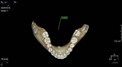 26 牙冠部可见白色充填物,距髓腔较近,3个牙根尖均位于上颌窦底.