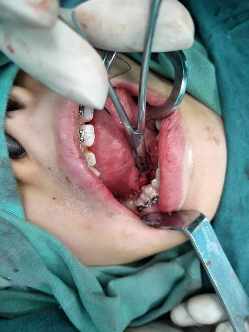 先天性颌下腺导管狭窄,手术分享.