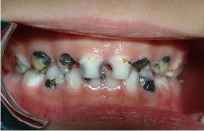 牙齿上出现黑斑是怎么回事_惠州麦芽口腔医院