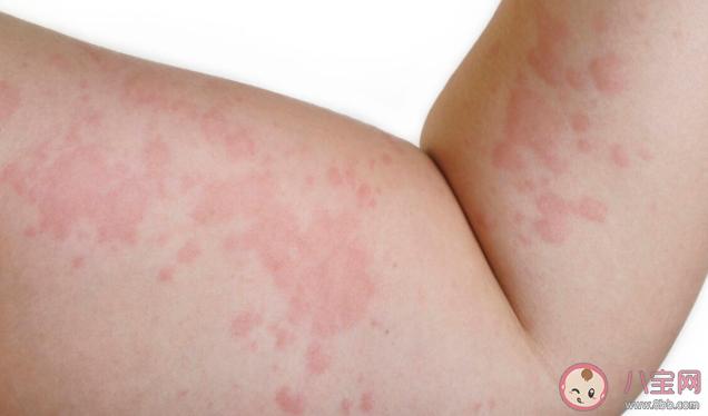 为什么春天容易皮肤过敏 长湿疹和湿气有关系吗
