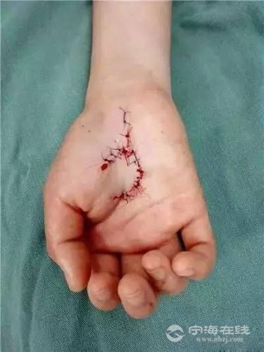 20岁女生手掌被割破,看着都疼!家有这样的扫帚拖把要注意!