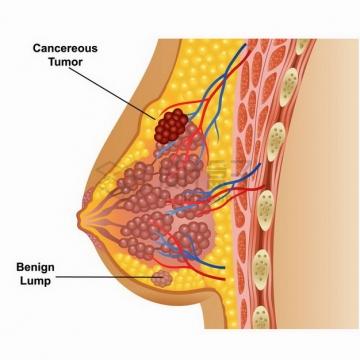 乳腺癌示意图女性乳房解剖图人体器官组织结构png图片免抠矢量素材