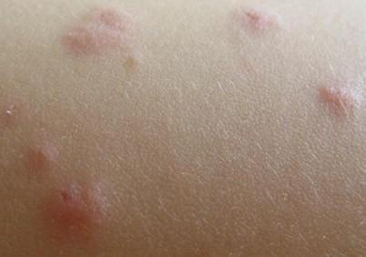 湿疹根据病程发展情况可分为急性,亚急性和慢性湿疹三种表现症状