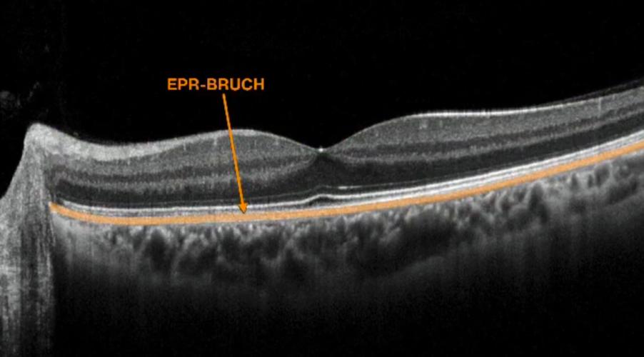 视网膜正常oct图
