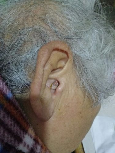友友们,我妈妈七十三了耳朵里科肿瘤,要这么才能切除这科肿瘤呢.