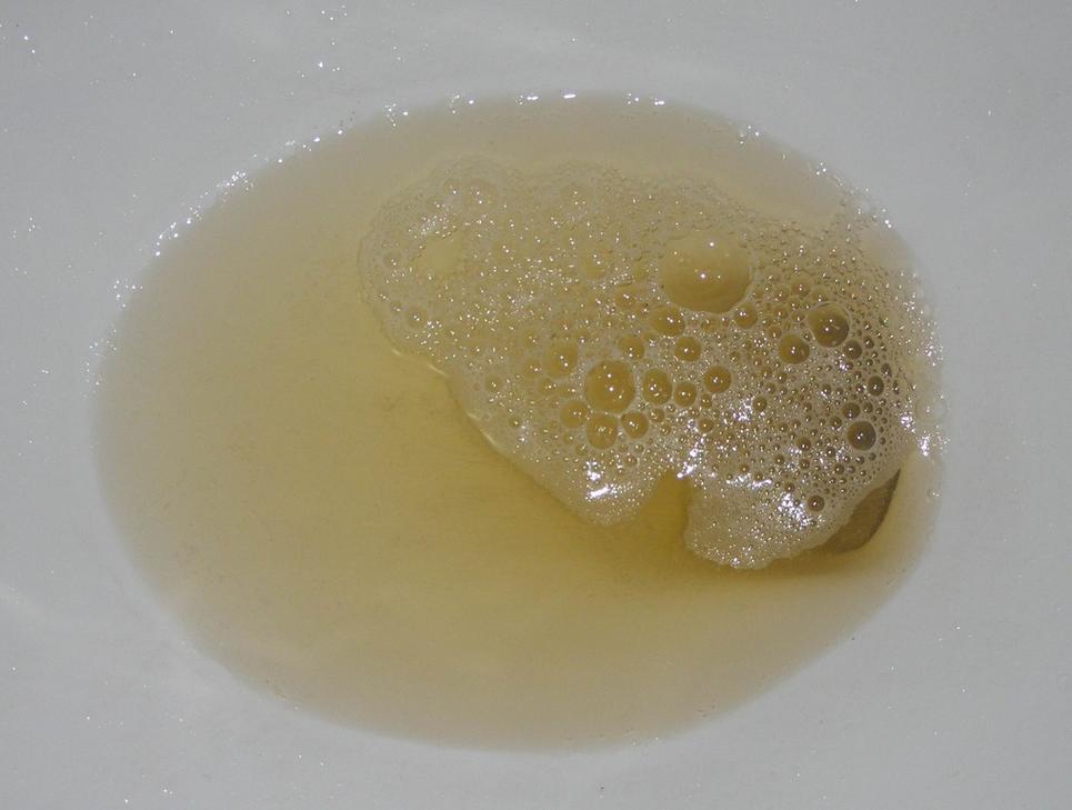 究竟什么样的尿是含蛋白的泡沫尿?