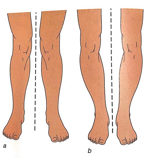 第五步:膝外翻和膝内翻分析:一侧大腿的肌肉体积偏大提示该侧使用次数