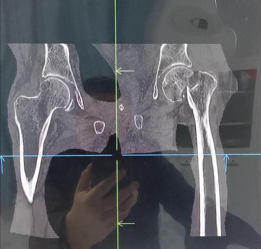 马某某,男,78岁,左股骨颈骨折(头下型),行人工股骨头置换术,术后四天