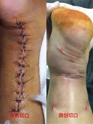 近日,临汾市中心医院骨科团队成功完成一例跟腱断裂患者的通道微创