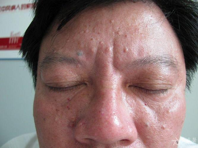 面部丘疹--老年性皮脂腺增生