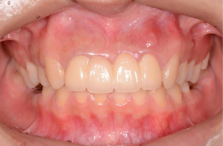 前牙隐裂,种植牙美学修复 - 好大夫在线