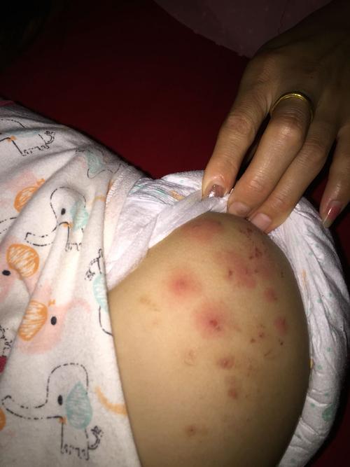 医生好,我宝宝一周岁零两个月,身上长这种痘痘很痒,什么原因?