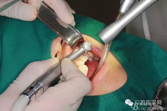 一例左上侧切牙根尖切除术