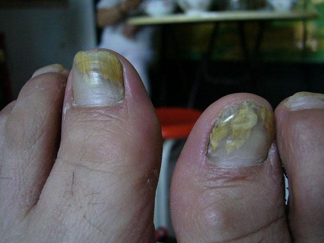 图灰指甲容易传染吗得了灰指甲一个传染俩真的那么恐怖吗