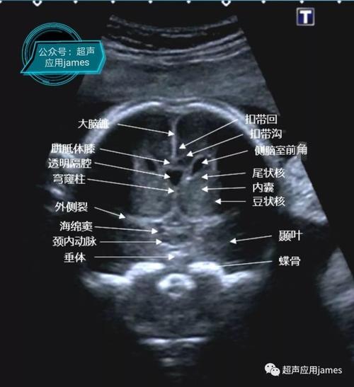 新知达人, 胎儿颅脑斜冠状面超声图像解析