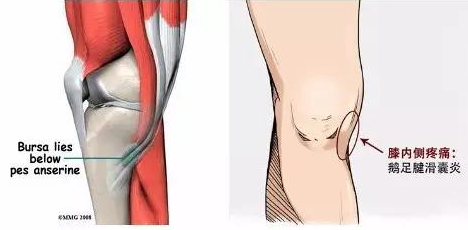 容易被漏诊的膝内侧痛之鹅足腱炎