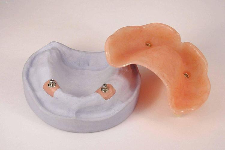 是一类以附着体为主要固位形式的可摘局部义齿,活动-固定义齿或固定桥