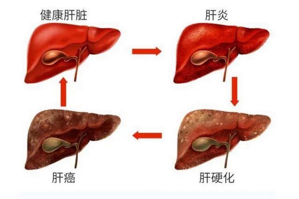 肝硬化是一种慢性,进行性的肝脏疾病,其发病机制比较复杂,但病情通常
