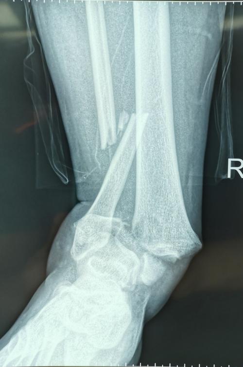 特殊类型踝关节骨折:logsplitter损伤