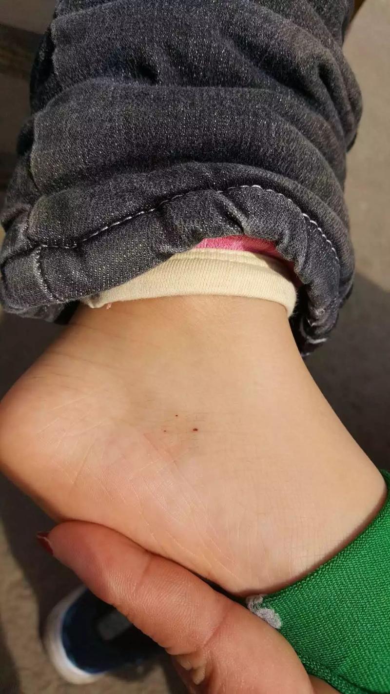 吉林市一幼儿园老师用针扎孩子孩子屁股脚上有疑似针眼