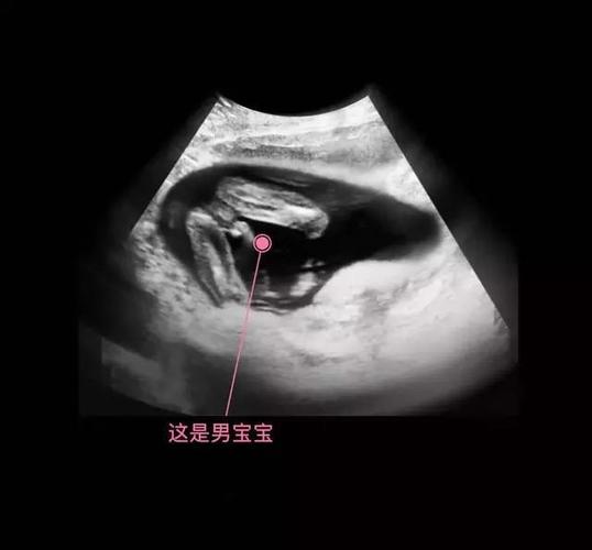 二胎孕妈, 四维排畸顺利通过, 同时确定男孩一枚! 附症状传好孕啦
