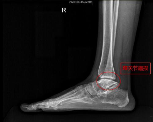 严重,距骨扁平变形术后左侧踝关节x片正侧位显示,胫骨端为第四代假体