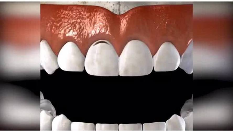 牙齿出现楔状缺损了该怎么办呢大家平时千万不要横着刷牙哦