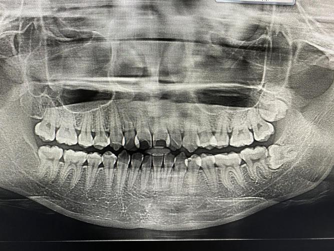放个牙片镇楼【方案】隐适美 上颌扩弓,下排推磨牙后移,医生说偏颌