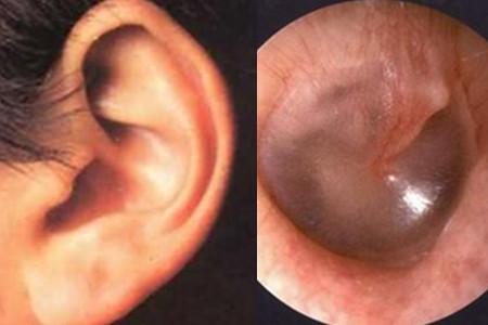 【图】耳膜穿孔能自愈吗 情况严重的需要通过手术来修补