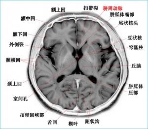 高清颅脑断层解剖图谱磁共振大体标本