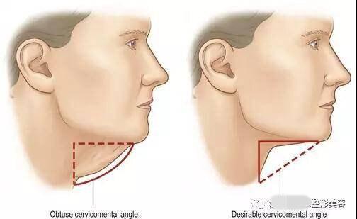 这些效应累积在一起,逐渐导致颏颈角(cma)增大和下颌缘轮廓不清晰