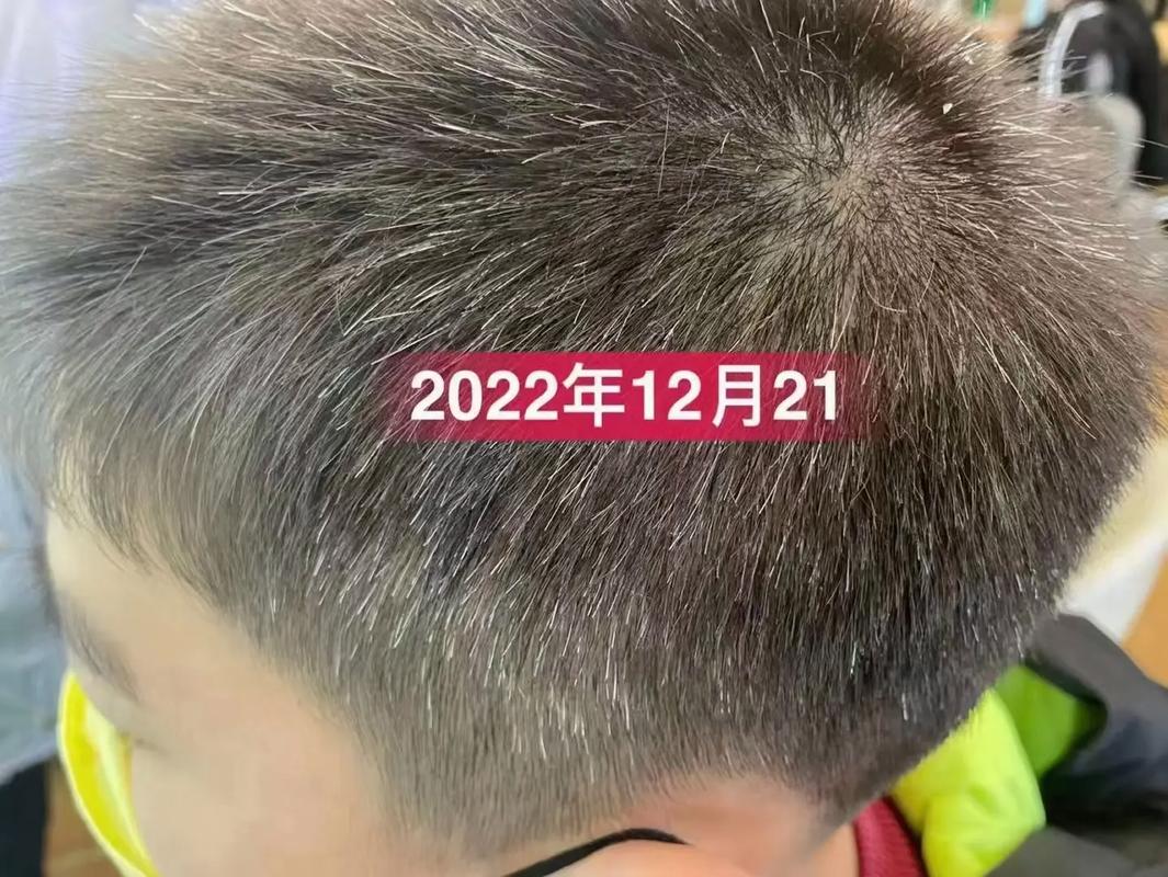 少年白发12岁小男孩9699调理3个月的效果#白发变黑发关注 - 抖音