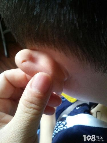 孩子耳朵上出生就有个小洞洞,据说这是聪明洞?