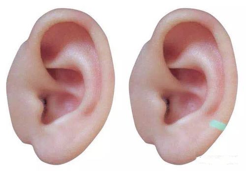 轮垂切迹定义:耳轮和耳垂后缘之间的凹陷处(如下图所示)轮屏切迹定义