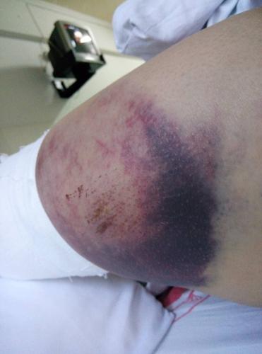 因出车祸摔伤,大腿有个很大的肿块,黑紫色,消肿后,黑紫色还会变回原来
