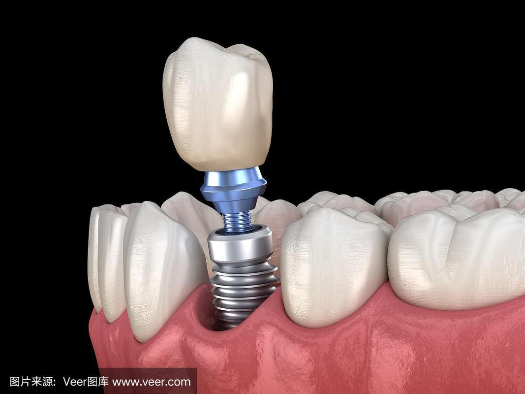 前磨牙种植修复.医学上精确的人类牙齿和假牙概念的3d插图