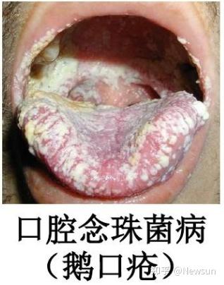 口腔念珠菌病在hiv感染者的口腔损害中最为常见,常表现为红斑型或假膜