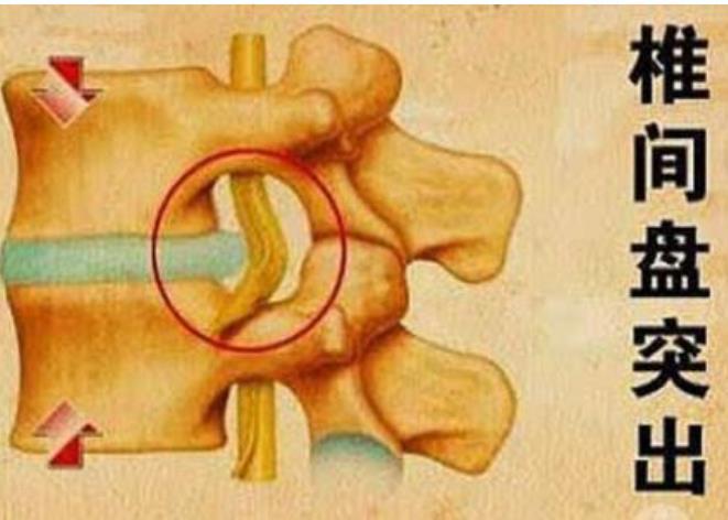 腰椎间盘突出与膨出有什么区别,主要是由什么原因造成的?-常青藤健康