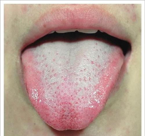 舌苔苔质:厚,腻,润;苔色:白.【临床意义】心火旺,脾气虚,血瘀,痰湿.