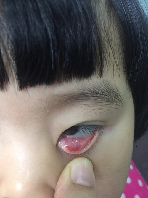 医生您好,孩子两岁半,两个月前左下眼睑内长了两个霰粒肿,请问_李小燕