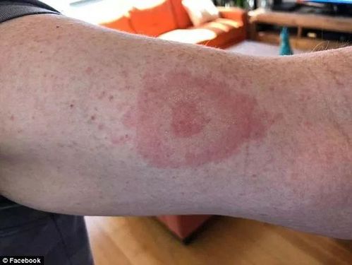 手臂出现了红肿新州一名男子被蜱虫叮咬后近日人们越来越多的走向户外