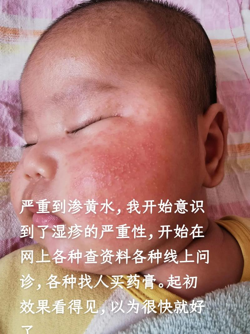 宝宝的湿疹主要是在脸上,因为从来没有接触 - 抖音