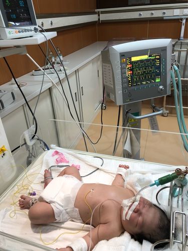 国际医院新生儿科第一例呼吸机应用